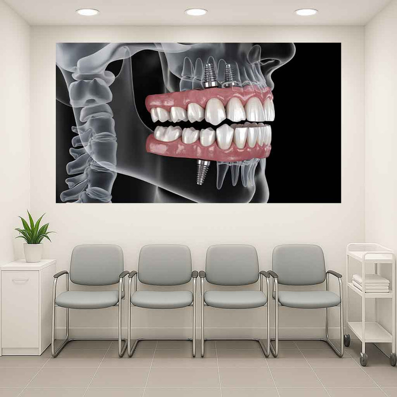 پوستر طرح   دندانپزشکی مدل ایمپلنت دندان کد AR3061423